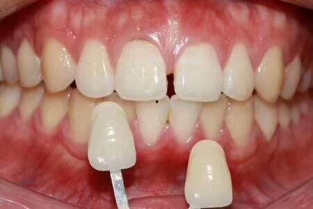 大牙缝网红,揭秘网络红人的魅力与争议